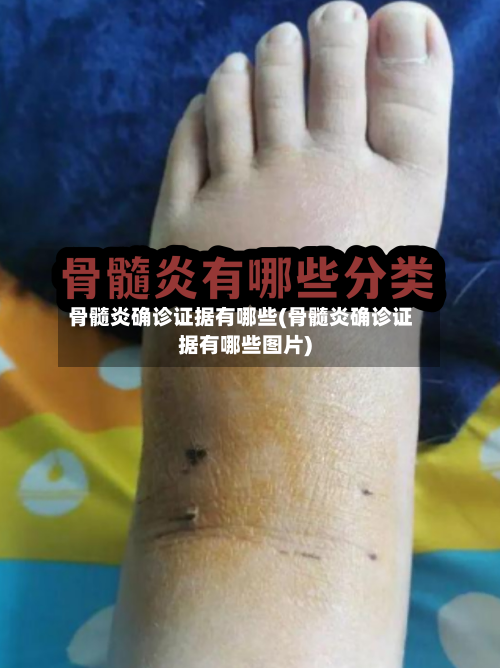 骨髓炎确诊证据有哪些(骨髓炎确诊证据有哪些图片)