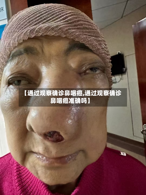 【通过观察确诊鼻咽癌,通过观察确诊鼻咽癌准确吗】